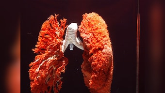 Finding it hard to breathe? Get screened for chronic obstructive pulmonary disease, say doctors