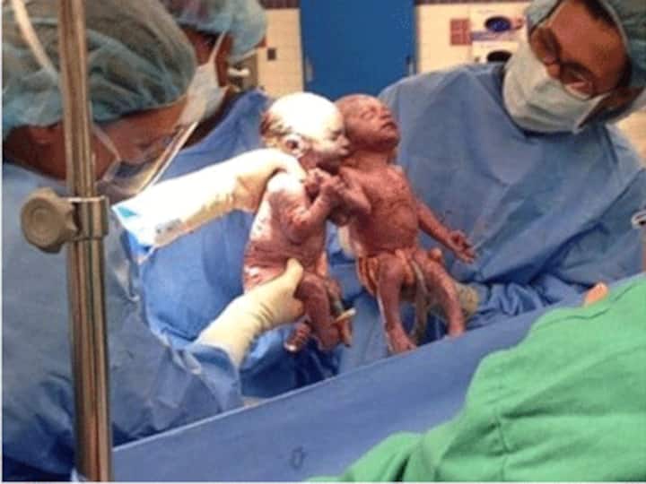 Mother's Day viral photo: Twin girls holding hands after birth