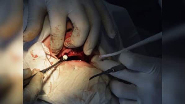 Get this: Mumbai doctors extracted 232 teeth from teenager