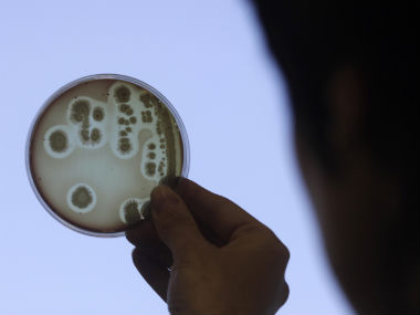 UCLA says more than 100 were exposed 'superbug' in California hospital  UCLA says more than 100 were exposed 'superbug' in California hospital