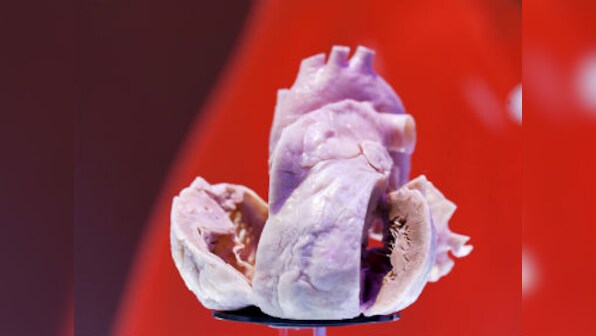 Govt cuts coronary stent prices by 85 percent in major relief to cardiac patients