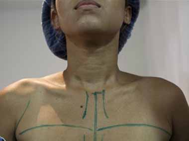 Venezuelan women frustrated with shortage in breast implants Venezuelan women frustrated with shortage in breast implants