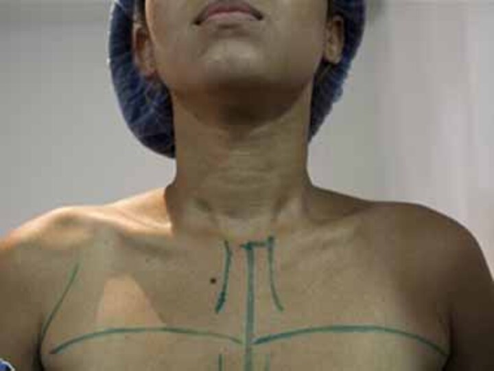 Venezuelan women frustrated with shortage in breast implants