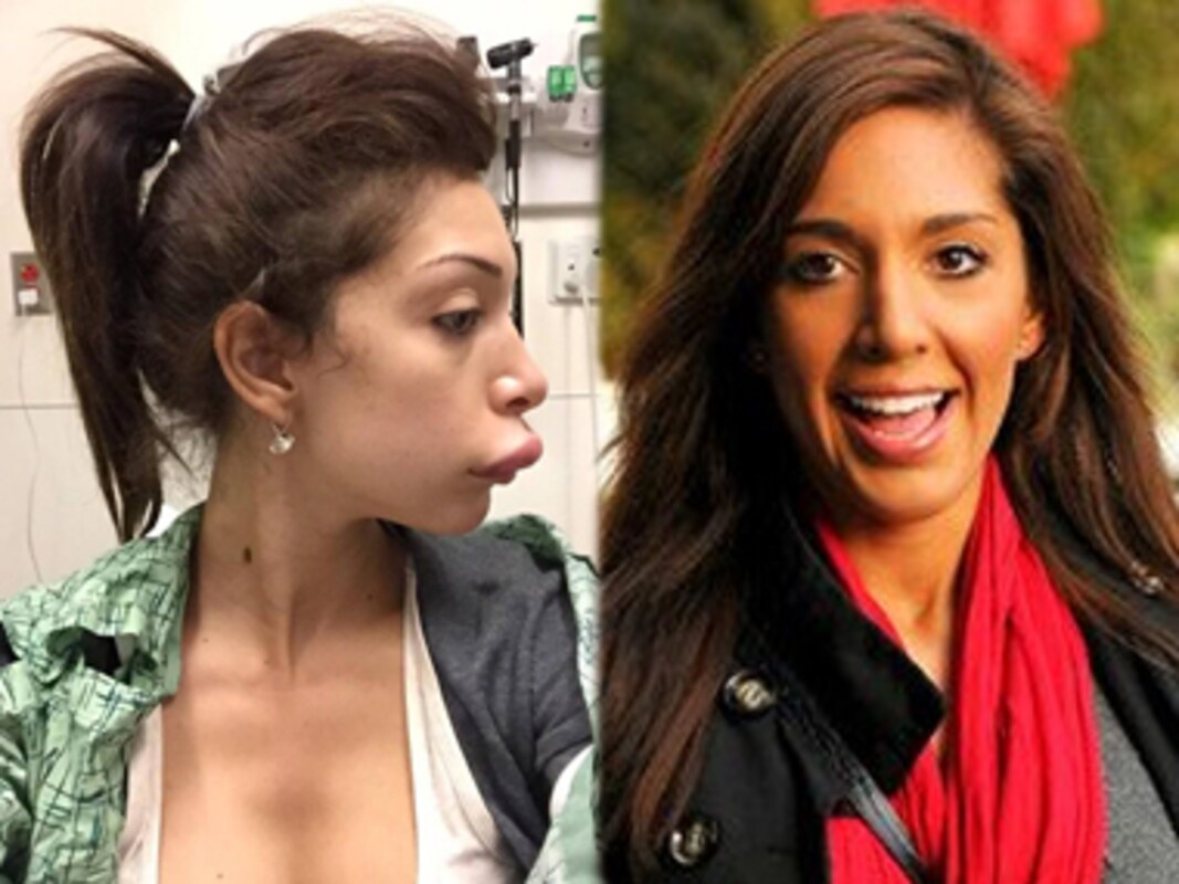 Iran Porn Star Nose Job - Messed up: Here's how porn star Farrah Abraham looks after her botched lip- job-Living News , Firstpost