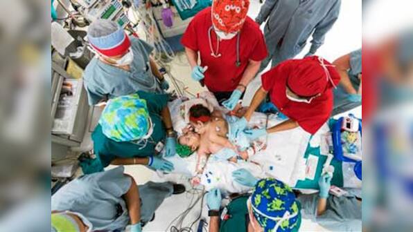 US doctors perform 26-hour surgery to separate conjoined twins