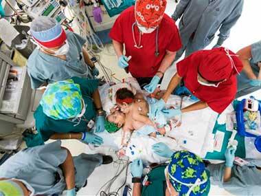 US doctors perform 26-hour surgery to separate conjoined twins