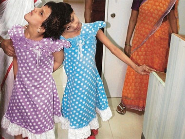 12 years on, conjoined twins Veena and Vani find hope of happy separation 12 years on, conjoined twins Veena and Vani find hope of happy separation