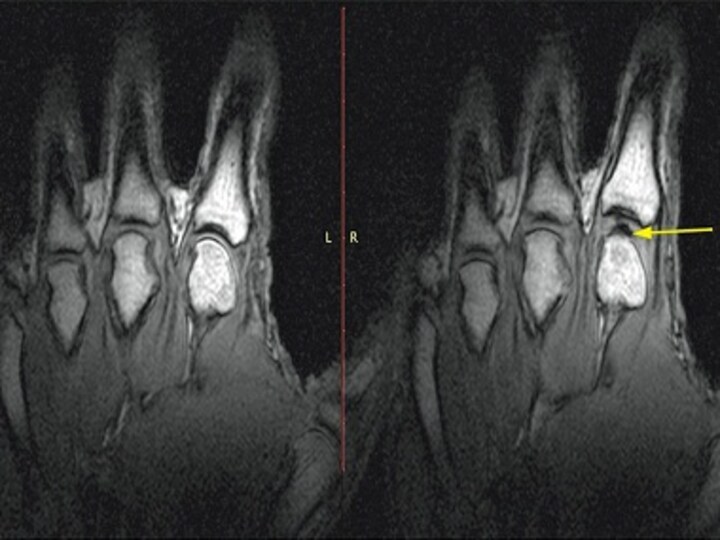 Revealed: Here's what really happens when you crack your knuckles