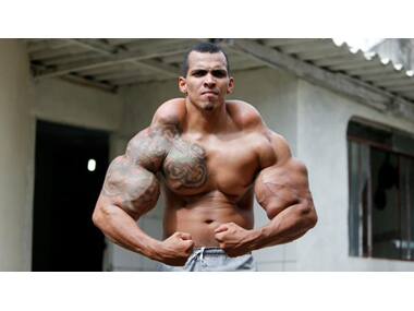 Man injects oil and alcohol in muscles to look like the Hulk, almost loses his arms