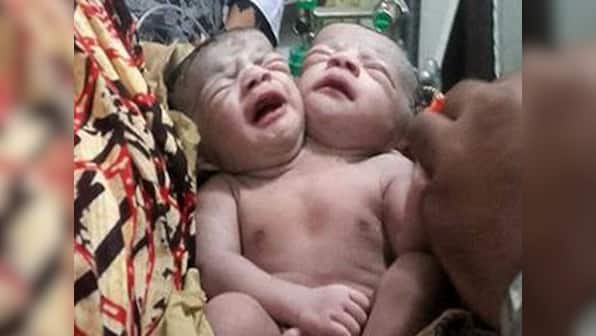 Baby born with two heads in Bangladesh as crowds queue for glimpse of 'miracle girl'