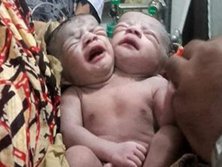 Baby born with two heads in Bangladesh as crowds queue for glimpse of 'miracle girl'