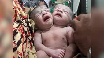 'Miracle baby' born with two heads, two hearts, one body dies in Bangladesh