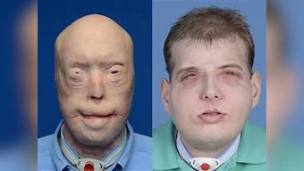 Most extensive face transplant ever: Burned firefighter gets new face, scalp