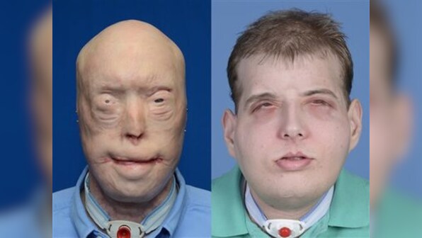 Most extensive face transplant ever: Burned firefighter gets new face, scalp