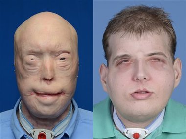 Most extensive face transplant ever: Burned firefighter gets new face, scalp Most extensive face transplant ever: Burned firefighter gets new face, scalp