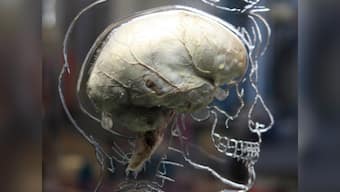 Skin cells to kill brain cancer: Researchers develop new method to fight deadly tumour
