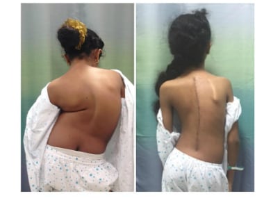 The patient's spine before and after the surgery