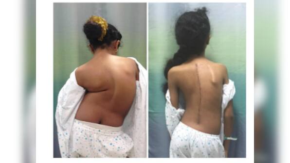 Surgeons at HN Reliance Hospital successfully treat 10-year-old African girl for rare spinal deformity