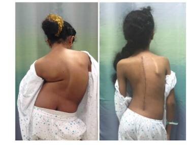 Surgeons at HN Reliance Hospital successfully treat 10-year-old African girl for rare spinal deformity