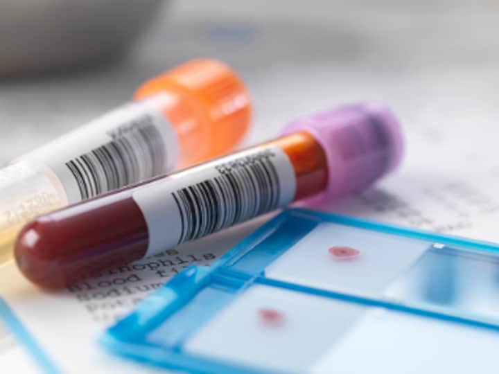 Blood test may sound early warning of skin cancer relapse