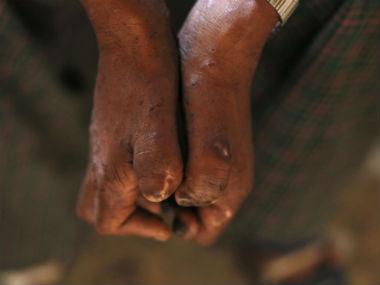 India is key to the WHO's call for a leprosy-free Earth India is key to the WHO's call for a leprosy-free Earth