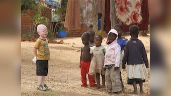 In Malawi, albinos are killed for body parts that are believed to bring good luck