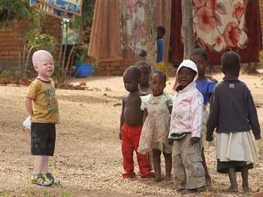 In Malawi, albinos are killed for body parts that are believed to bring good luck In Malawi, albinos are killed for body parts that are believed to bring good luck