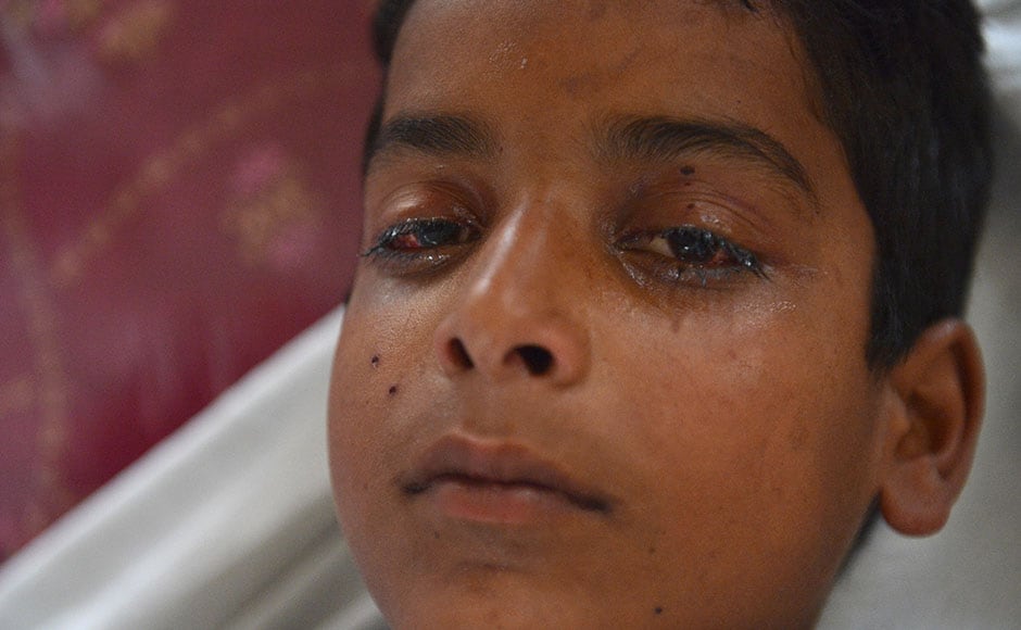 A wounded Kashmiri boy, with an injured eye, lies on a hospital bed after being hit by pellets fired by Indian security forces during a protest, at a hospital in Srinagar on July 13, 2016. Hospitals in Kashmir are overwhelmed, with hundreds of wounded patients pouring in as the region reels from days of clashes between anti-India protesters and government troops.