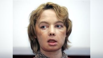 Isabelle Dinoire, world's first face transplant patient, dies at 49