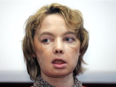 Isabelle Dinoire, world's first face transplant patient, dies at 49 Isabelle Dinoire, world's first face transplant patient, dies at 49