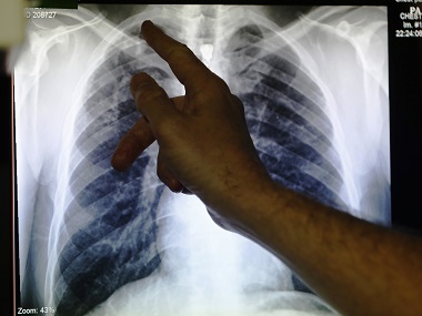 India's ailing battle against TB: One in five multidrug-resistant patients do not complete treatment India's ailing battle against TB: One in five multidrug-resistant patients do not complete treatment