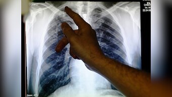 Tuberculosis deaths rise for first time in more than decade due to COVID-19 pandemic