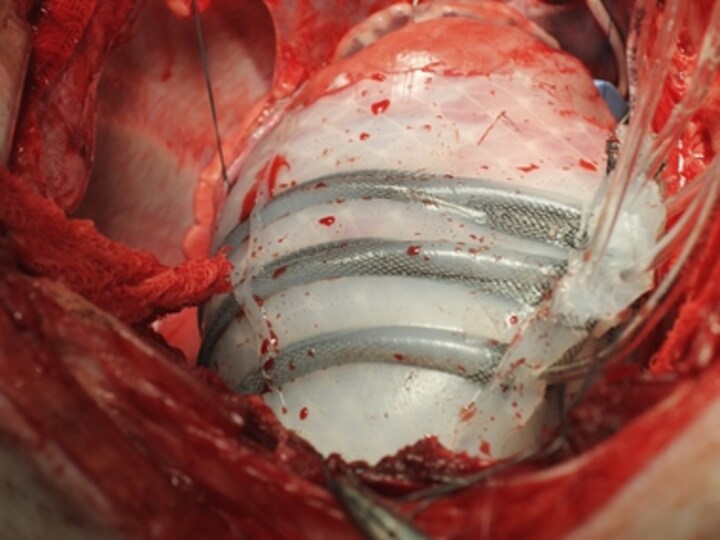 Soft robotic sleeve makes heart beat like cardiac muscle
