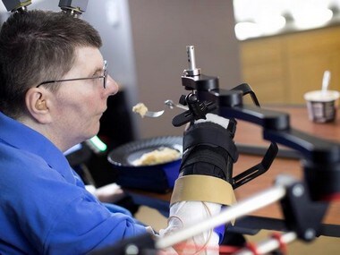 Bill Kochevar, 56, is using computer-brain interface technology and an electrical stimulation system to move his own arm. Reuters