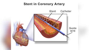 Medical stent regulation row: Govt's move to prohibit companies from withdrawing stents is wrong