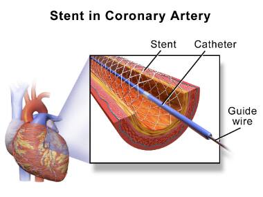 Nepal cashes on as India's price cap send stents disappearing from country