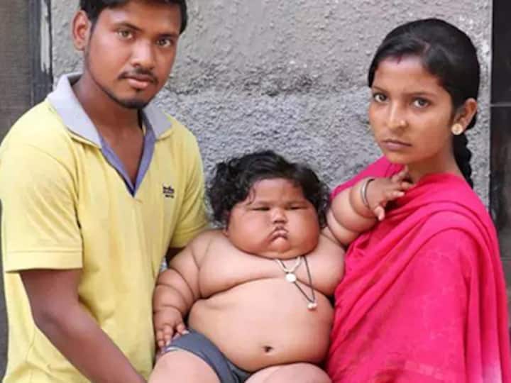 Watch: Eight-month-old-baby weighing 17 kg baffles doctors