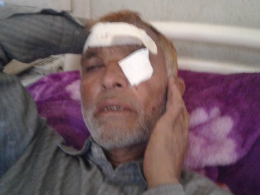 Kashmir unrest: Pellet injuries pile up as clashes over death of Hizbul commander Sabzar Bhat continue Kashmir unrest: Pellet injuries pile up as clashes over death of Hizbul commander Sabzar Bhat continue