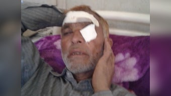 Kashmir unrest: Pellet injuries pile up as clashes over death of Hizbul commander Sabzar Bhat continue