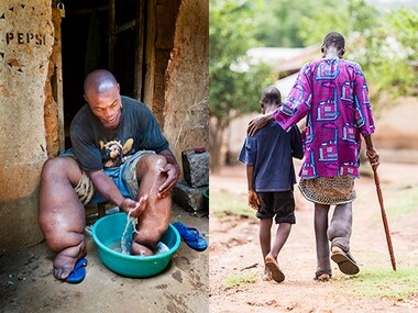 Scientists discover that addition of drug albendazole has no advantages in the treatment of Lymphatic filariasis