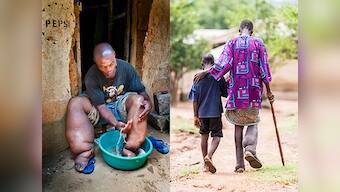 Scientists discover that addition of drug albendazole has no advantages in the treatment of Lymphatic filariasis