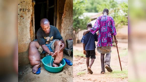 Scientists discover that addition of drug albendazole has no advantages in the treatment of Lymphatic filariasis
