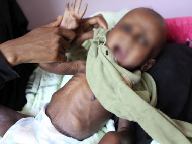 Study links underweight children in urban India with social backwardness, illiteracy and lack of toilets Study links underweight children in urban India with social backwardness, illiteracy and lack of toilets