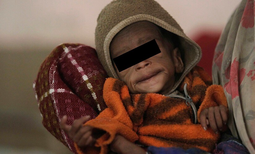 Study links underweight children in urban India with social backwardness, illiteracy and lack of toilets