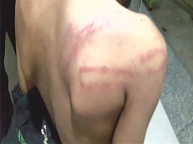 Hyderabad teacher beats up 5-year-old UKG student with stick at school; boy hospitalised Hyderabad teacher beats up 5-year-old UKG student with stick at school; boy hospitalised