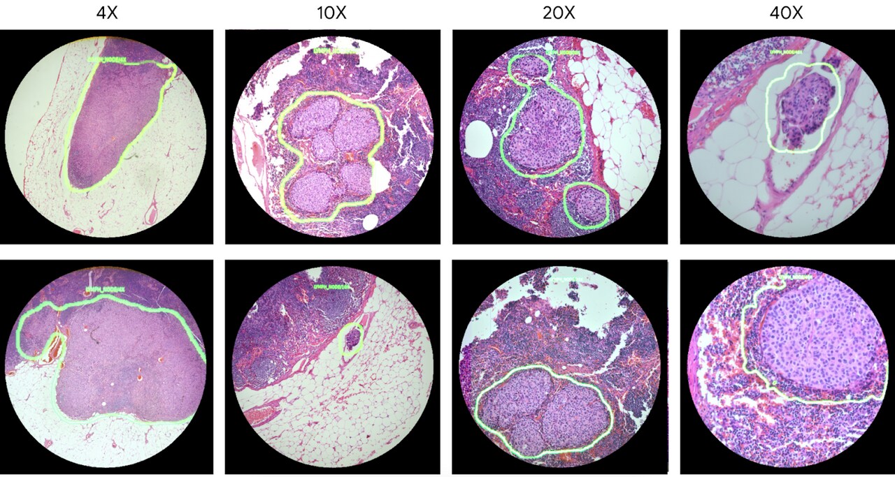 These images show examples of the lymph node metastasis model with 4x, 10x, 20x, and 40x microscope objectives. Image: Google
