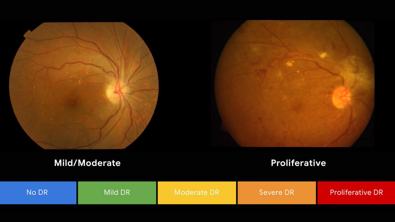 Google AI helping in detecting defect in the cornea. Image: Google
