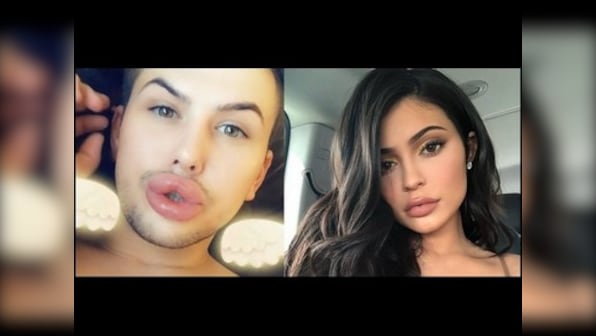 Kylie Jenner's fan tries imitating her pout, excessive fillers spill out of lips