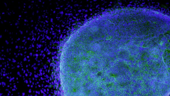 Study show some women more likely to develop cervical cancer, help in early detection