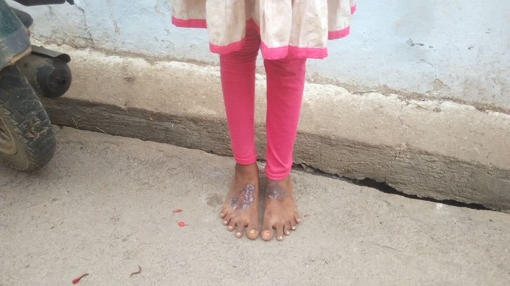Gangotri, now 12, shows us the blisters on her feet. — ALL PHOTOS COURTESY THE WRITERS